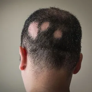 Alopecia Areata