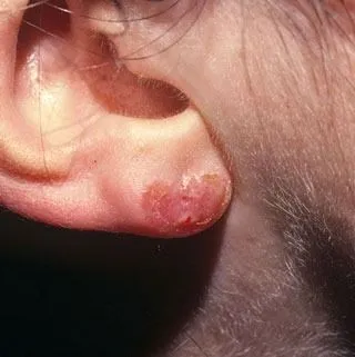 <strong>
</picture>Allergic Reaction to Nickel - Ear Lobe</strong> <p>This shows a rash that was caused from a nickel allergy.  The allergic rash is from the nickel (metal) in the earring. It is red, crusty and moist.</p>