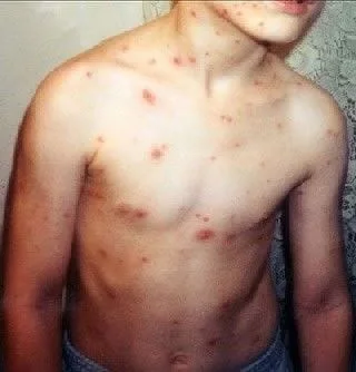 chickenpox rash