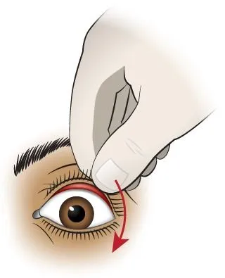 <strong>
</picture>First Aid - Foreign Object Under Upper Eyelid</strong> <ul><li>If particle cannot be seen, it's probably under the upper lid, the most common hiding place. </li><li>Try to open and close the eye several times while it is submerged in a pan or bowl of water. </li><li>If this fails, pull the upper lid out and draw it over the lower lid. This action, and your tears, will sometimes dislodge the particle. </li></ul>