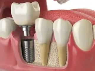 realistic 3d illustration of gums and teeth, showing tooth roots in gums and embedded dental implants Placerville, CA