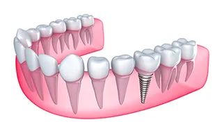 illustration of mouth, gums, and natural teeth with embedded dental implants Hilo, HI dentist