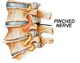 NUCCA and Pinched Nerves