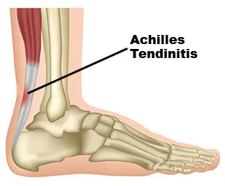 Avenel Podiatrist | Avenel Achilles Tendinitis | | Family Podiatry Center |