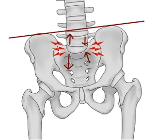 Tilted pelvis from a leg length discrepency