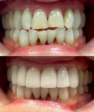 Veneers