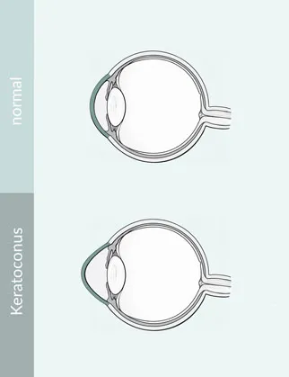 Corneal Cross Linking Diagram