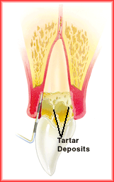 Advanced Periodontitis