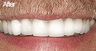 After Teeth