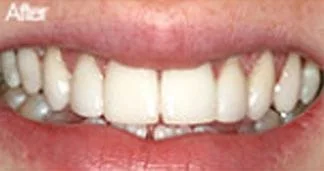 After Teeth