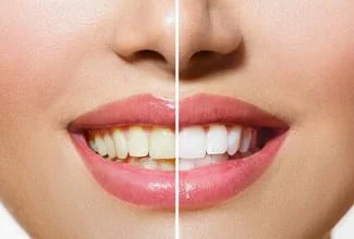 before and after image showing yellowed teeth in woman's mouth on left half of image and whiter teeth on right half after professional teeth whitening Lee's Summit, MO dentist