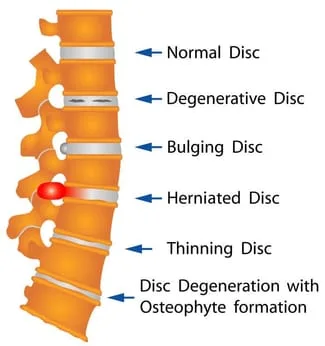 herniated disc, injury and pain chiropractic doctor in Stone Mountain 