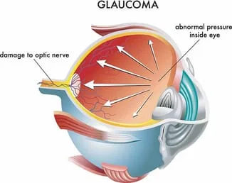medical-illustration-causes-glaucoma