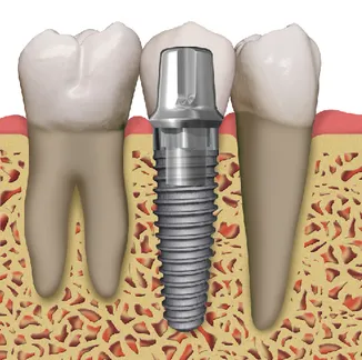 Dental Implants | Dentist in Saluda, SC | Saluda Smilemakers