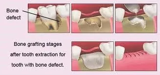 Bone Grafting