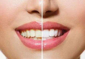 before and after image of woman's face, smiling mouth, left half has yellowed teeth, right half shows whiter teeth after professional teeth whitening Shelby, NC dentist