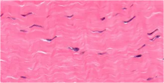 Microscopic Adhesion Fibrosis