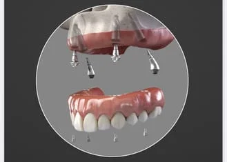 medicare dental implants