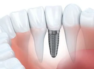 computer illustration of natural teeth and gums, embedded implant to replace missing tooth, dental implants Detroit, MI dentist