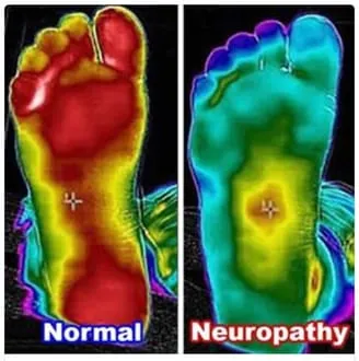 Neuropathy Thermal Scan Image
