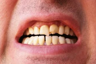 Cracked Teeth needing Emergency Dentist, Antioch TN