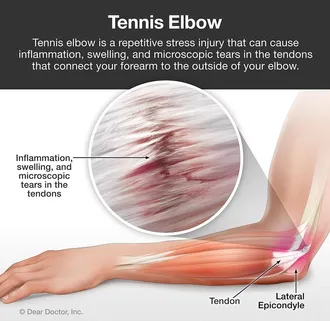 Tennis Elbow | Basalt, Aspen, Carbondale, Spine Spot Chiropractic