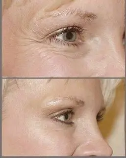 Botox Before & After