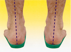 Feet_on_Orthotics.gif