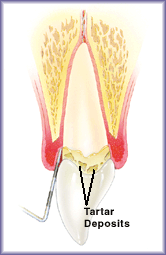 Mild Periodontitis