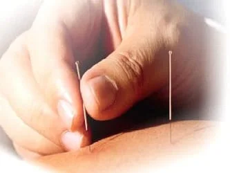Acupuncture.33160608_std.jpg