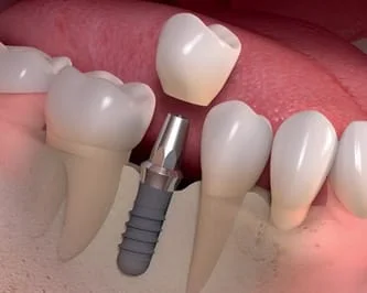 Dental Implants In Berryville, VA