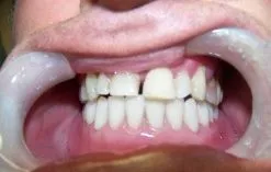 overdenture_after