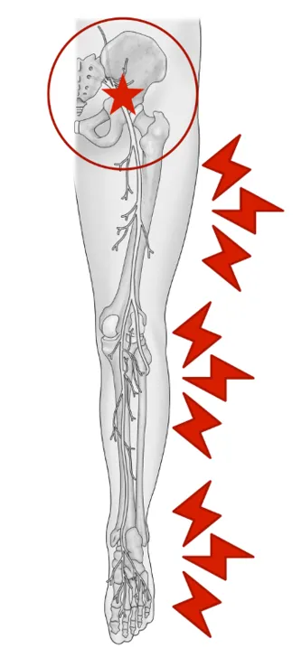 sciatica