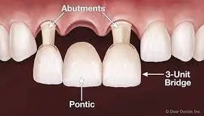 illustration of 3 unit dental bridge being placed over abutment teeth in top arch, dental bridge Mt Airy, NC dentist