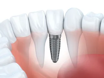 Vancouver Dental implants