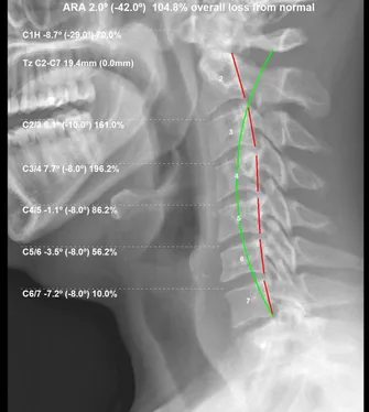 Jacob's x-rays