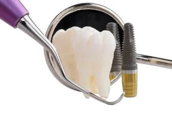 Dental Implants Cupertino, Dental Implants Specialist