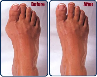 Before and after bunion treatment