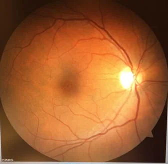 retina photo