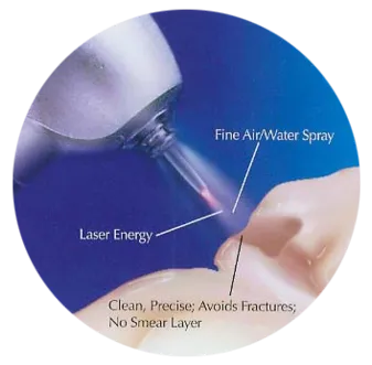 illustration of Waterlase dental laser being used on tooth, laser dentistry Longmont, CO