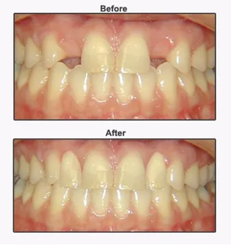 Complimentary Dental Implant Consultation
