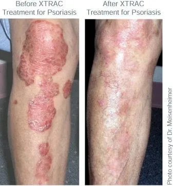 Psoriasis Treatment Picture