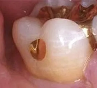 gold tooth filling