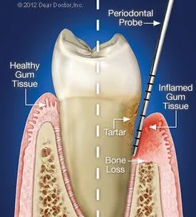 illustrated diagram of tooth with periodontal disease Cypress, TX