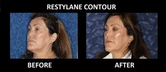 Restylane Contour