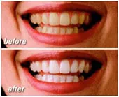 before and after image of woman's mouth, results of teeth whitening Mahwah, NJ