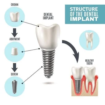 Lincoln, NE dental implants