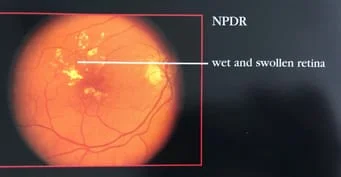 wet and swollen retina
