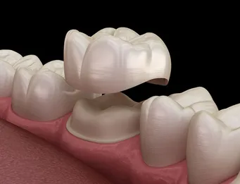 Damaged Tooth Repair With a Dental Crown - Frankford Dental Care