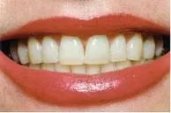 Whitening1